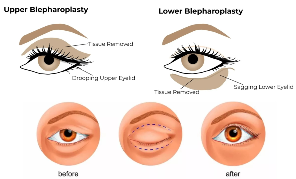 Blepharoplasty